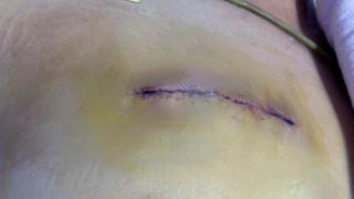 微创置换心脏瓣膜天花板级别手术!仅5cm小切口,完成根部扩大+双瓣置换+三尖瓣成形