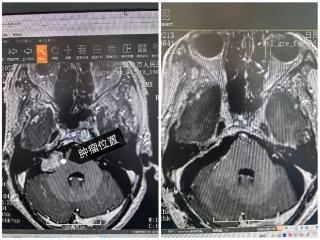 日照市人民医院：疼痛、耳聋折磨7年！手术搞定……
