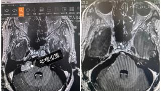 日照市人民医院：疼痛、耳聋折磨7年！手术搞定……