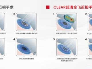 听说你准备做CLEAR超清全飞近视激光手术？这份术前到术后完整指南请收好