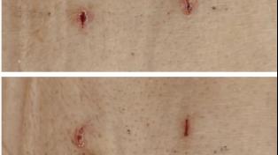 别让“骨折”压垮晚年！青岛西海岸第二医院微创“骨水泥”技术，为高龄脊柱骨折患者“撑腰”