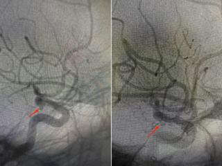 脑动脉瘤“不定时炸弹”不用开颅？神经内科“国家队”密网支架微创拆弹，3天出院！