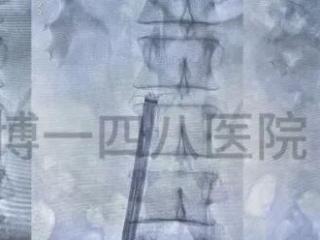 突破时限壁垒 淄博一四八医院成功取出滞留13年疑难滤器