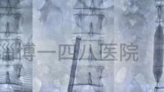 突破时限壁垒 淄博一四八医院成功取出滞留13年疑难滤器