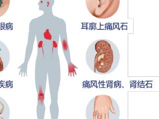 金蓓欣针对肾功能不全高尿酸患者的预防治疗优势