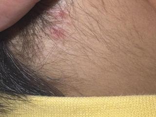 小叶医探|警惕！幼儿遭蜱虫叮咬，家长自行拔除险酿大祸