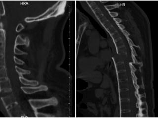 鏖战13小时登上“珠峰”！烟台山医院救治强直性脊柱炎合并严重脊柱损伤患者
