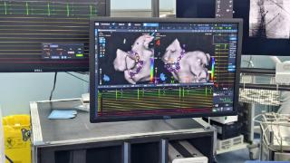 全省首例！日照心医完成山东省首例灌注压力脉冲消融手术