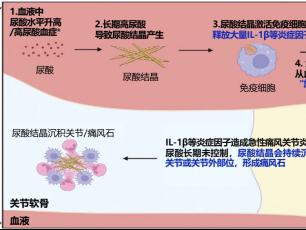 痛风急性发作如何快速缓解？金蓓欣（伏欣奇拜单抗）开启精准抗炎新路径