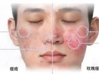 杏林医美：反复长痘别乱挤！全新战痘思路来了