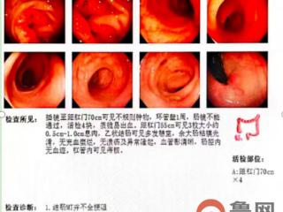 91岁高龄患者闯过手术“禁区”——青岛市胶州中心医院胃肠外科微创技术攻克高难度右半结肠切除术