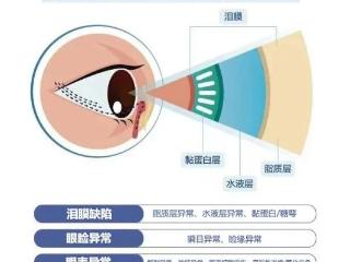 泰安光明爱尔眼科医生教你如何“告别”干眼症！