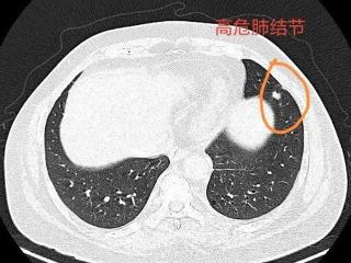 “穿刺活检 微波消融”为高危肺结节患者解决难题