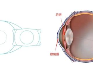 刘保松晶体松解术：新一代EVO+ICL V5晶体
