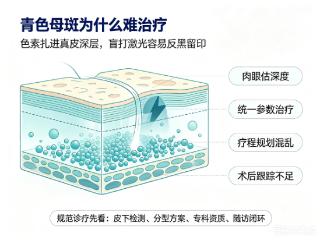 避坑攻略｜青色母斑深浅难处理，广州哪家诊疗更规范？