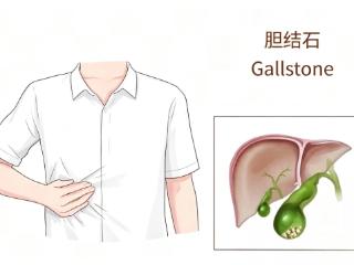 小小结石隐患大 科学护胆防未病