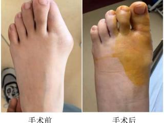 德州市中医院精准矫形助少年足履平地，骨伤一科成功完成12岁女孩先天性左足拇外翻手术